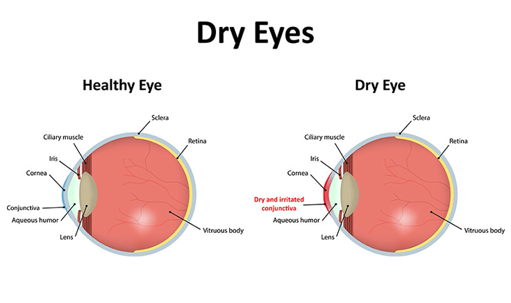 A comparison image of a clear vision and a vision blurred by cataracts.